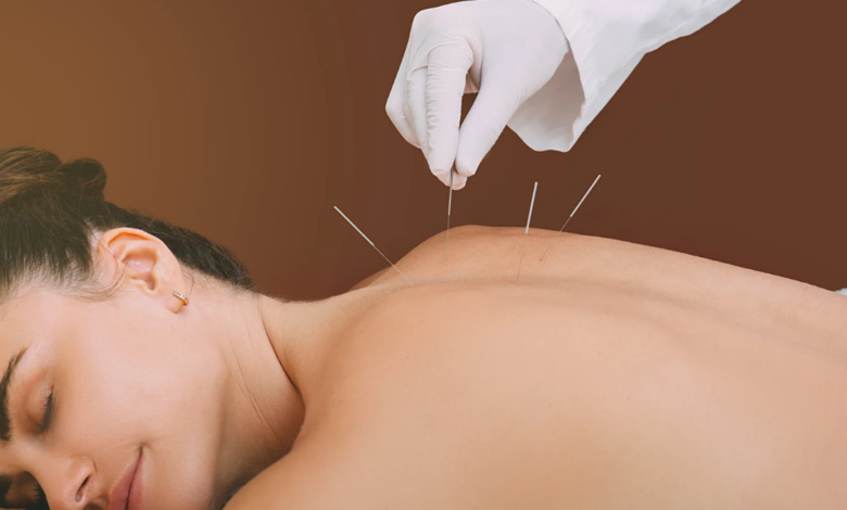 How Acupuncture Can Help Alleviate Headaches and Migraines