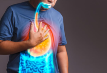 The Essential Steps for Managing Chronic GERD Symptoms Effectively